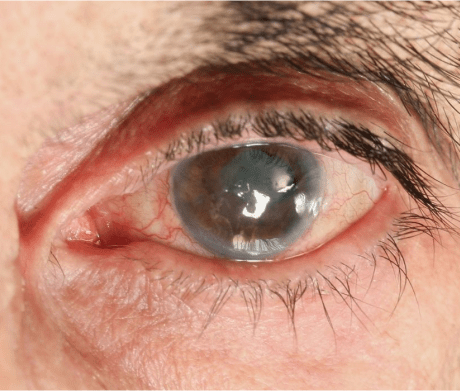dr manpreet global eye hospital