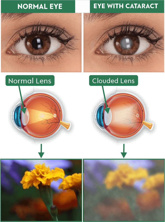dr manpreet global eye hospital
