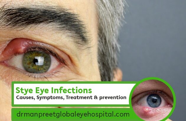 Stye eye infections