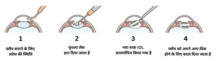 मोतियाबिंद किसे हो सकता