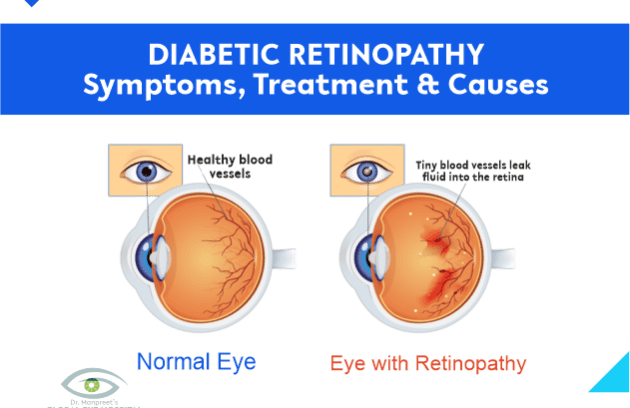 dr manpreet global eye hospital