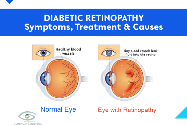 dr manpreet global eye hospital