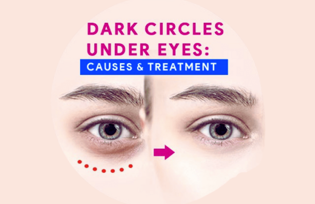 dark circles