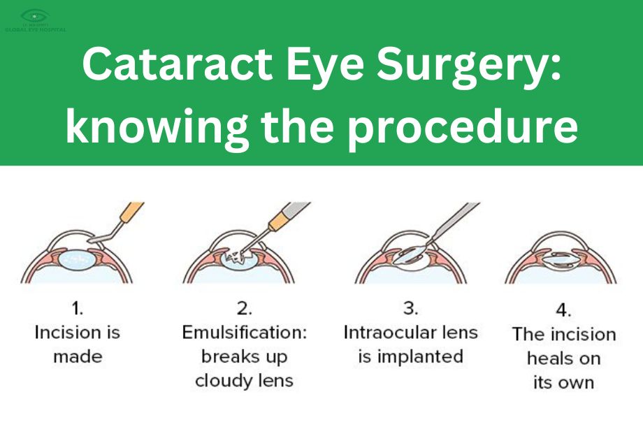 Cataract Eye Surgery
